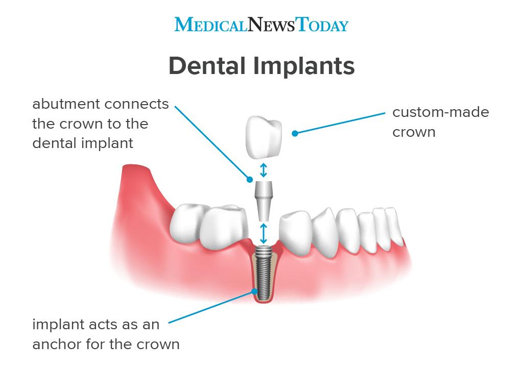 an infographic showing how dental implants work